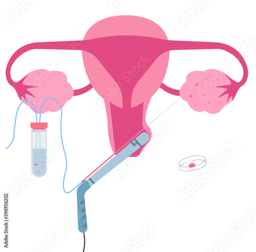 Transvaginal oocyte retrieval, one of in vitro fertilization or IVF procedure.