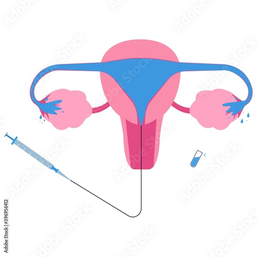 Hysterosalpingogram or HSG, x-ray procedure used to see fallopian tubes and uterus condition. Female reproduction test.