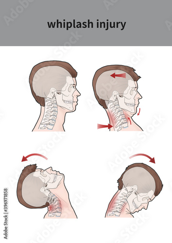 Medical illustration for explanation whiplash injury