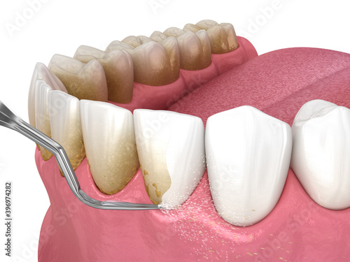 Oral hygiene: Scaling and root planing (conventional periodontal therapy). Medically accurate 3D illustration of human teeth treatment