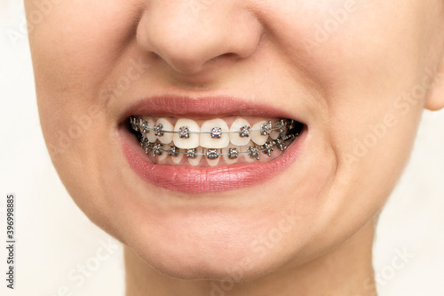 Closeup of woman with braces on teeth. Smiling face with braces isolated on white background. Orthodontic treatment concept. Closeup of healthy female mouth with metal braces.