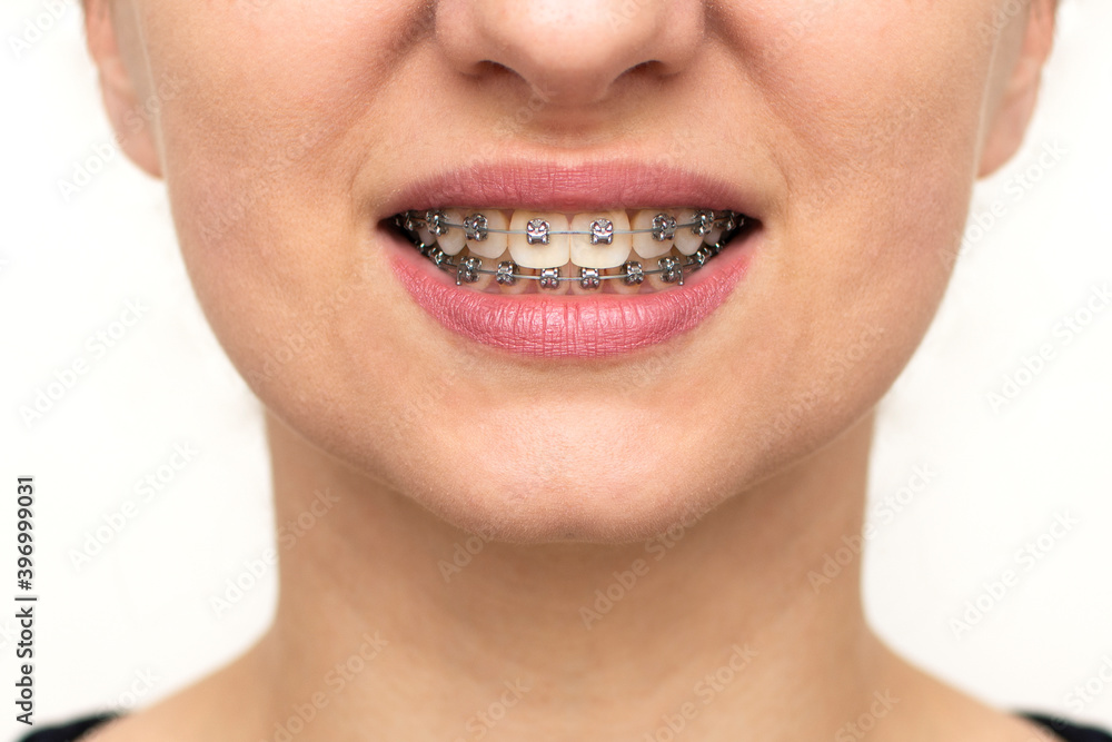 Closeup of woman with braces on teeth. Smiling face with braces isolated on white background. Orthodontic treatment concept. Closeup of healthy female mouth with metal braces. Closeup of woman with braces on teeth. Smiling face with braces isolated on white background. Orthodontic treatment concept. Closeup of healthy female mouth with metal braces.