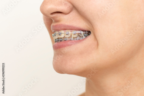 Closeup of woman with braces on teeth with elastics. Smiling face with braces isolated on white background. Orthodontic treatment. Closeup of healthy female mouth with metal braces. 