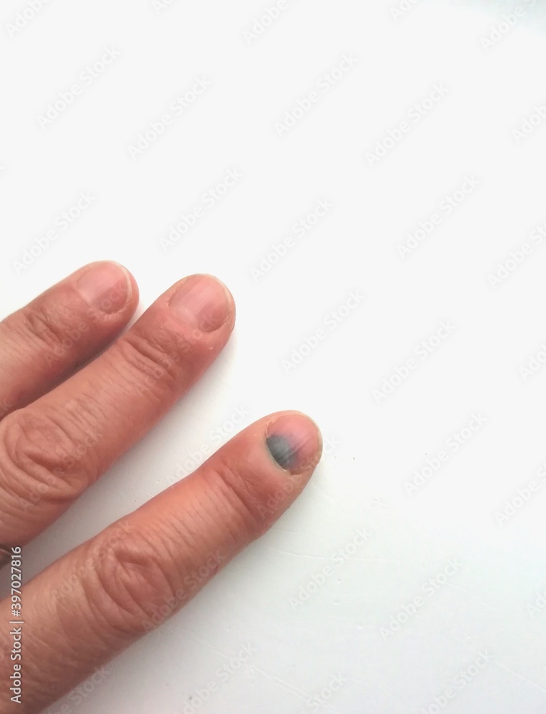 hématome sur un ongle suite à un traumatisme hématome sur un ongle suite à un traumatisme