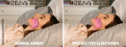 Illustrations showing difference between normal breathing and obstructive sleep apnea photo