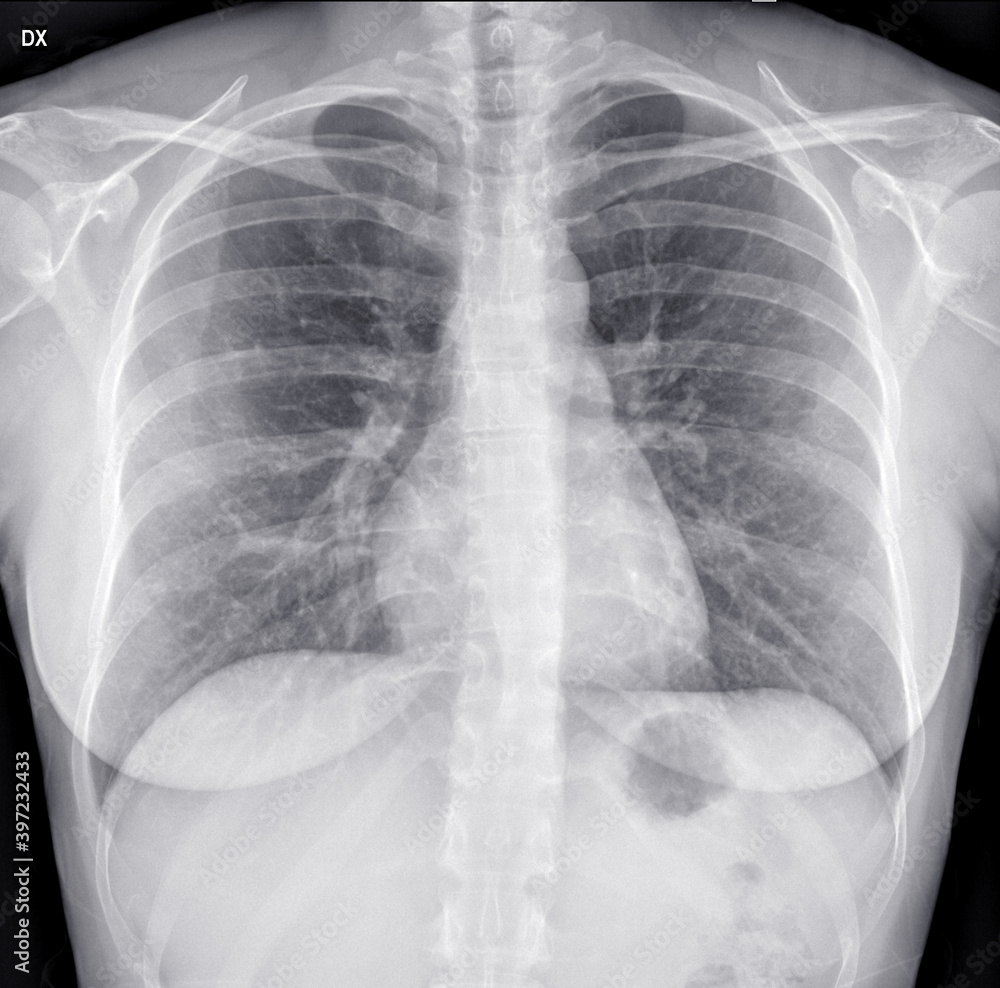 Woman chest x-ray. Frontal view. Woman chest x-ray. Frontal view.
