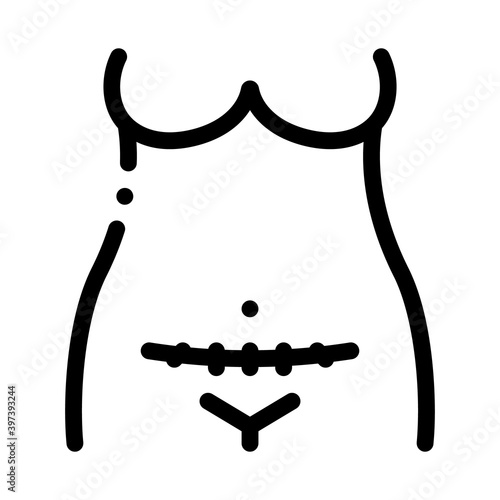 cesarean section black icon vector. cesarean section sign. isolated symbol illustration