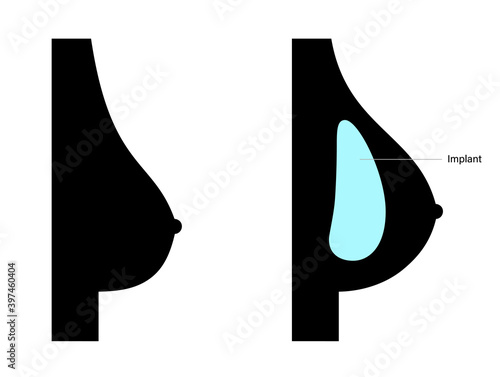 Breast Implant Concept