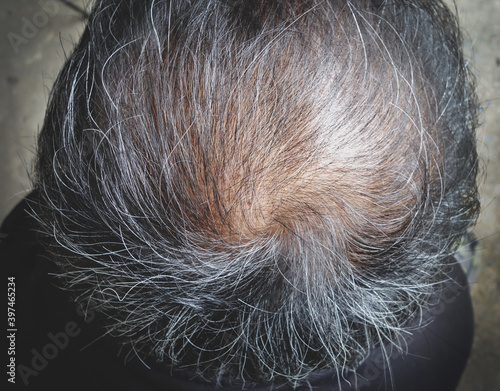 Gray hair / bald man,close-up.Hair loss, hair fall everyday serious problem, on white background.Solutions for hair loss. 