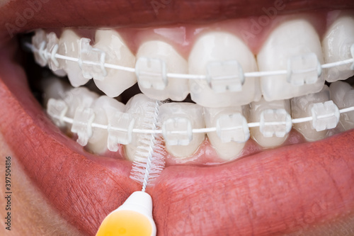 Female Cleaning Dental Brackets In Mouth