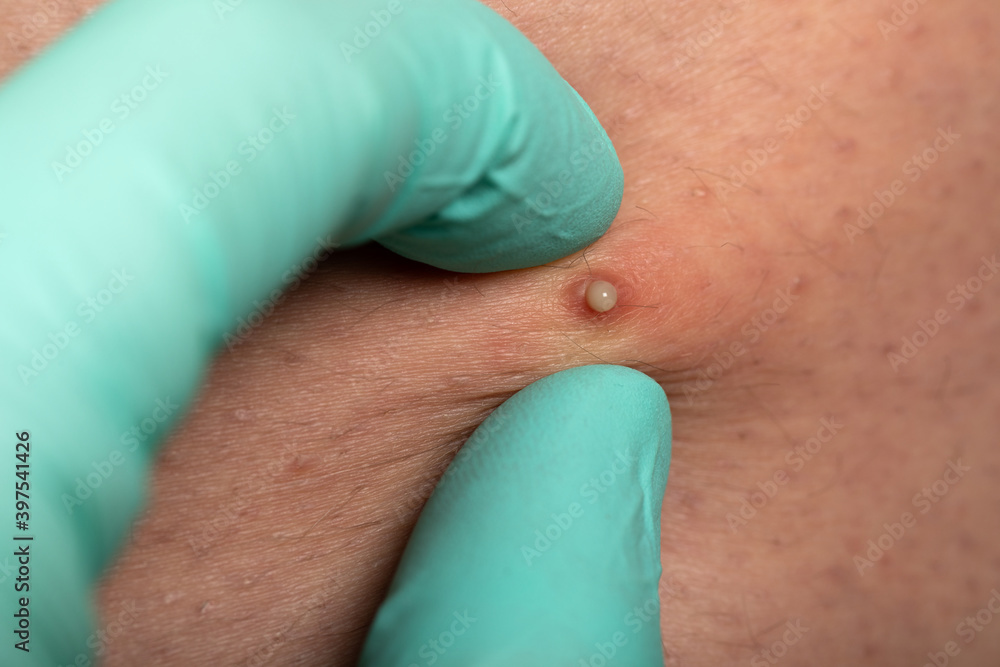 Folliculitis on human skin Folliculitis on human skin