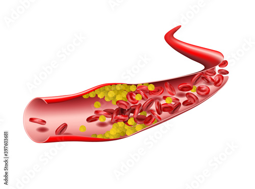In the vein, cholesterol stops the flow of red blood cells. Illustration