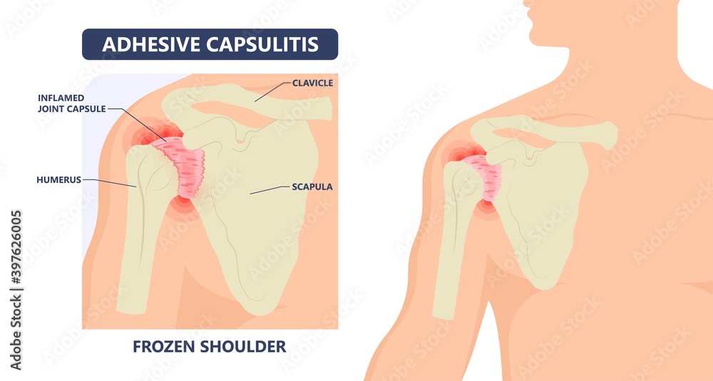 Frozen shoulder adhesive capsulitis surgery stiff crush ribs bone lift