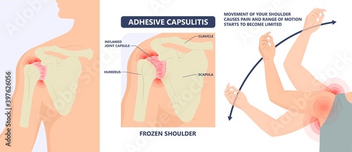 Frozen shoulder adhesive capsulitis surgery stiff crush ribs bone lift athletes arm rupture symptom freezing stiffness rheumatoid arthritis photo
