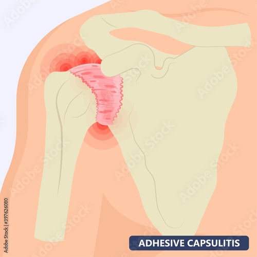 Frozen shoulder adhesive capsulitis surgery stiff crush ribs bone lift athletes arm rupture symptom freezing stiffness rheumatoid arthritis