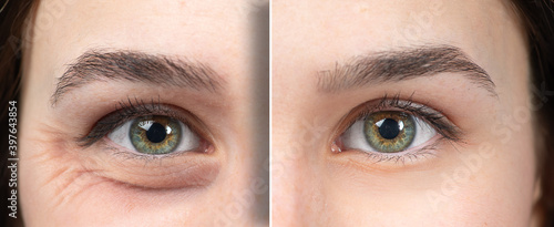 Photos Half face of a girl before and after a rejuvination treatment.