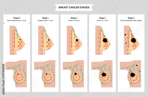 Breast disease concept