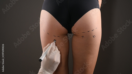 Closeup view of female buttocks marked for plastic operation, on gray background