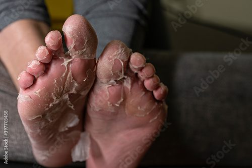 Stretched out feet displaying badly exfoliating skin photo