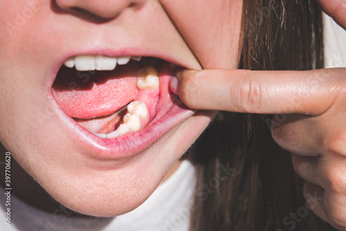 Bild auf Leinwand Young woman showing mouth without tooth on lower jaw