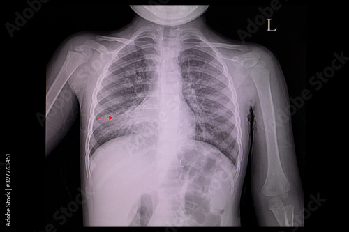 A chest x-ray film of a patient with right lung pneumonia photo