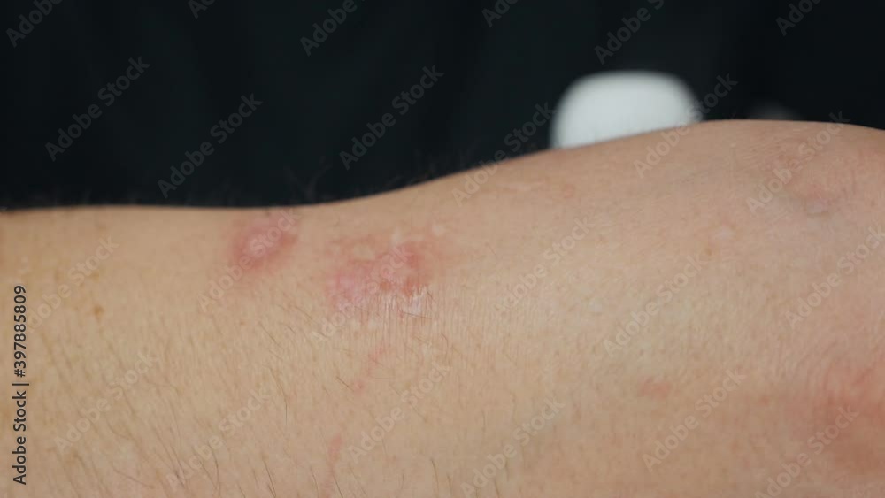 A wart on a hand was treated with a special medicine. A wart dermatology of a hand human skin close up A wart on a hand was treated with a special medicine. A wart dermatology of a hand human skin close up