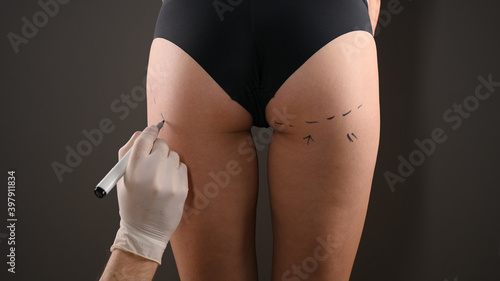 plastic surgeon marking womans body for surgery