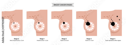 Breast disease concept