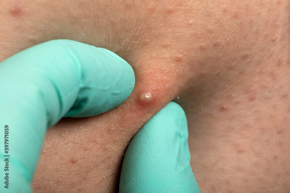 Fototapeta premium Folliculitis on human skin