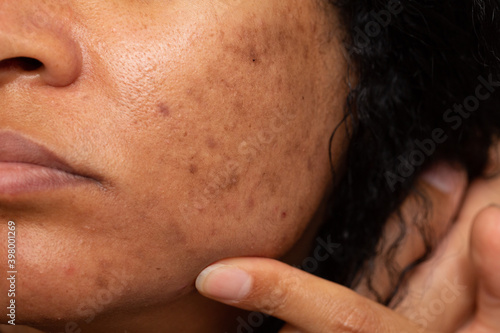 Closeup of Asian woman with dark spots and freckles problems. photo