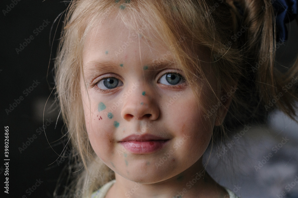 Little girl suffers from chickenpox Little girl suffers from chickenpox