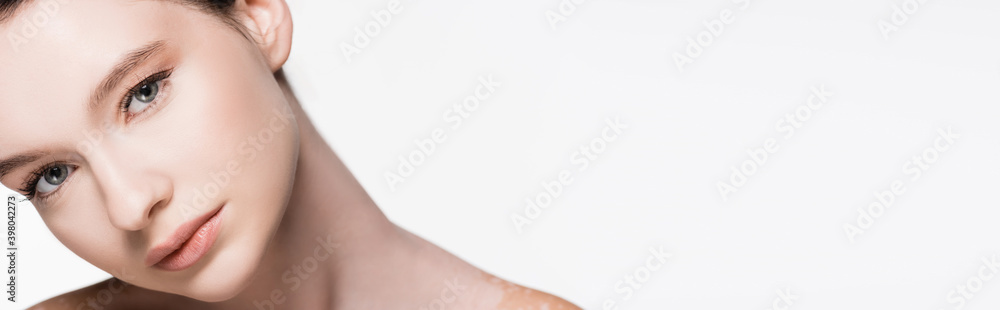 young beautiful woman with vitiligo isolated on white, banner