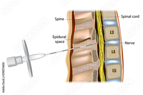 Epidural administration or Epidural anesthesia. Tuohy Epidural Needle. photo