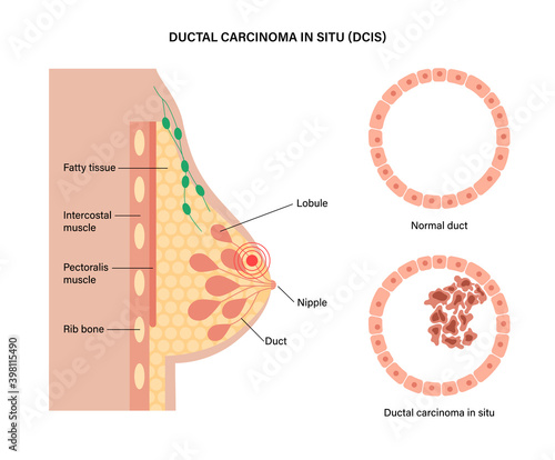 Breast disease concept