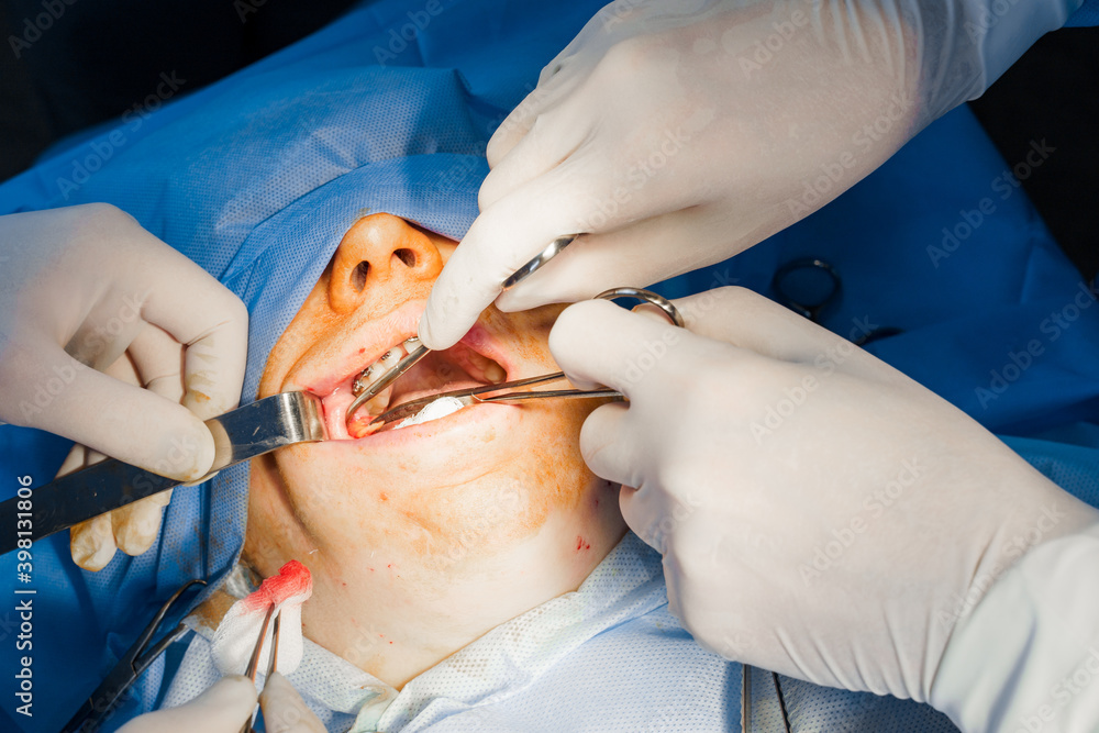 Buccal fat removal. Bisha lumps removal. Plastic surgery in clinic. Plastic surgery operation for modifying face in medical clinic. Buccal fat removal. Bisha lumps removal. Plastic surgery in clinic. Plastic surgery operation for modifying face in medical clinic.
