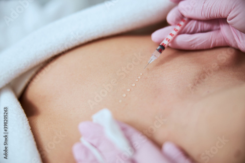Woman being treated for the decolletage wrinkles