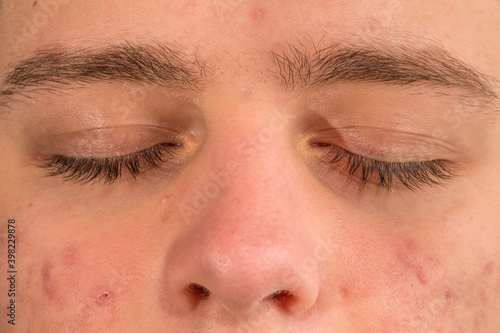 Severe Acne closeup view