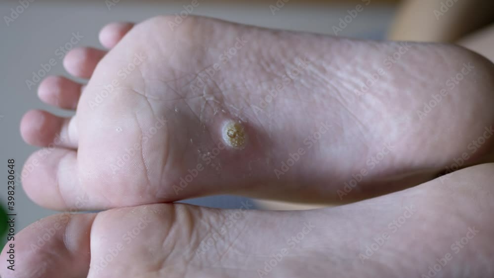 Callus and Wart Feet on Plantar Flat foot in Child. Flat feet. CloseUp