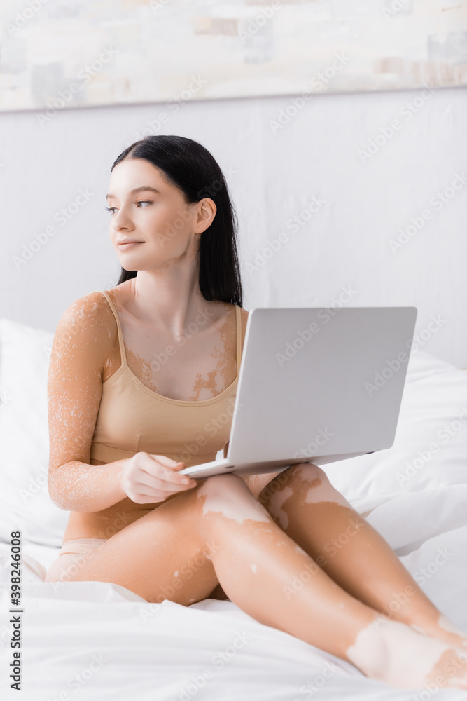 brunette freelancer with vitiligo holding laptop in bedroom brunette freelancer with vitiligo holding laptop in bedroom