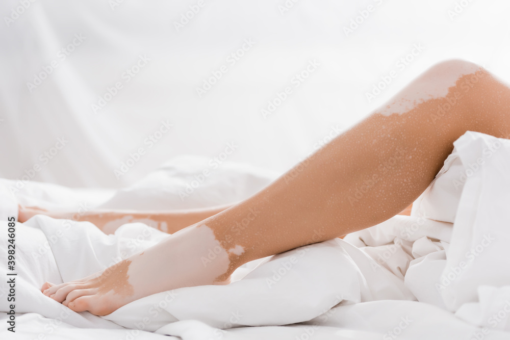 cropped view of legs of young woman with vitiligo on bed