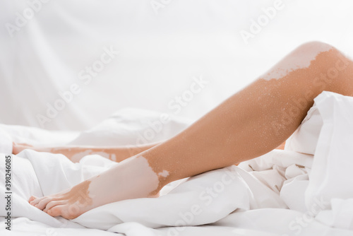 cropped view of legs of young woman with vitiligo on bed