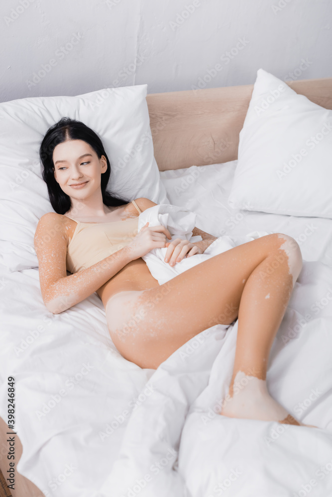 young cheerful woman with vitiligo lying on bed young cheerful woman with vitiligo lying on bed