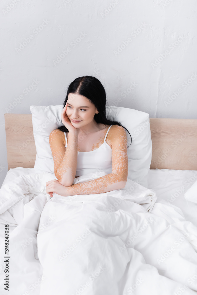 young woman with vitiligo looking away in bedroom young woman with vitiligo looking away in bedroom