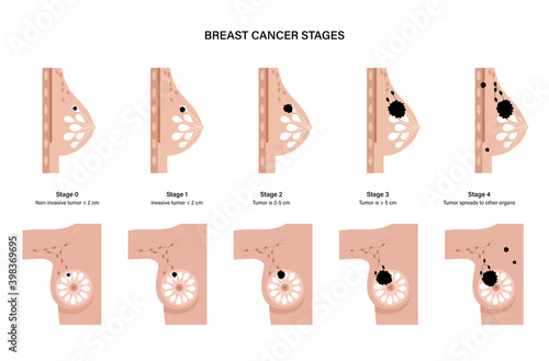 Breast disease concept