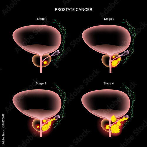 Prostate cancer concept