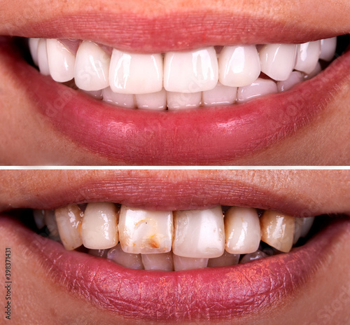 Perfect smile before and after bleaching procedure whitening of zircon arch ceramic prothesis Implants crowns. Dental restoration treatment clinic patient. Result of oral surgery dentistry, 