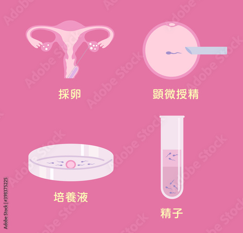 体外受精