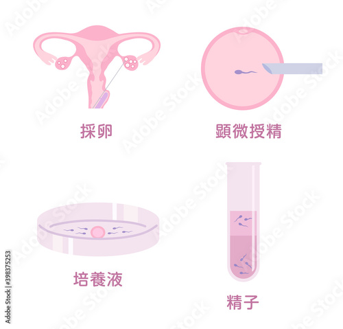 体外受精
