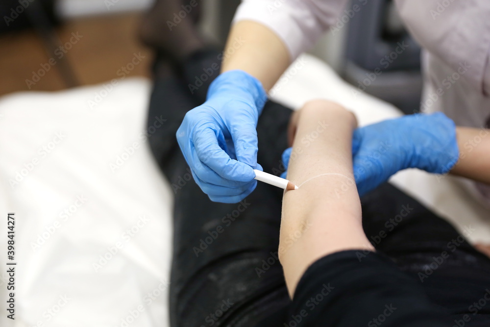 the hands of the cosmetologist apply a pencil marking on the patient's hand for laser hair removal