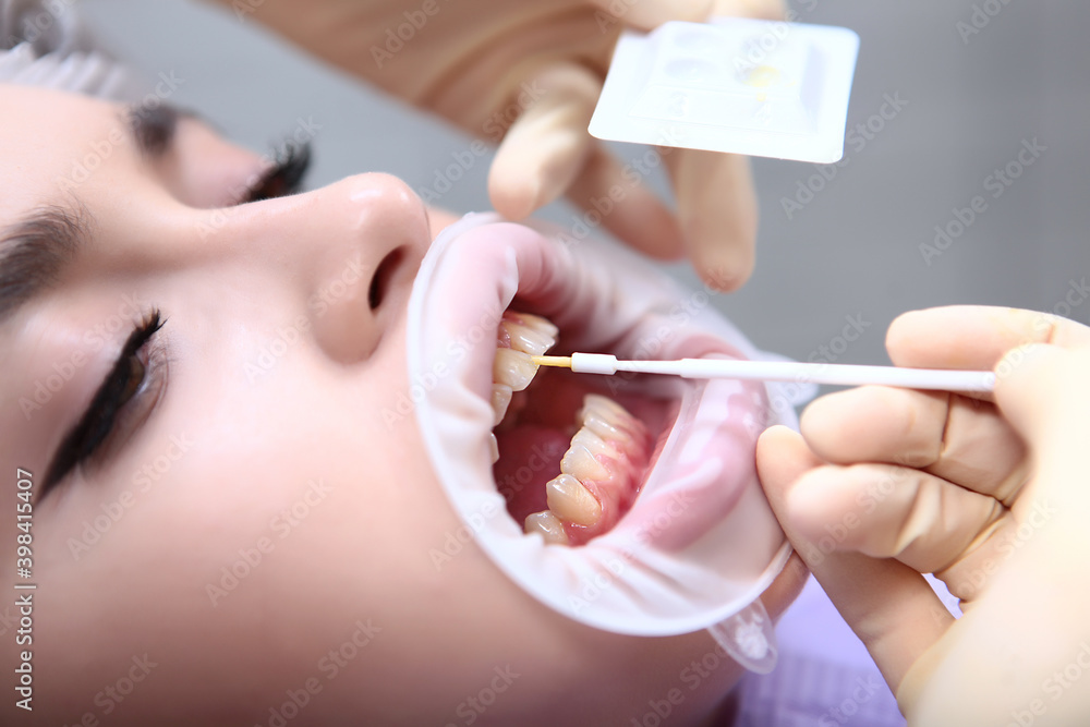 The dentist applies a protective gel to the teeth. Professional teeth cleaning. Hands in protective gloves. The concept of health. Prevention of caries. The dentist applies a protective gel to the teeth. Professional teeth cleaning. Hands in protective gloves. The concept of health. Prevention of caries.